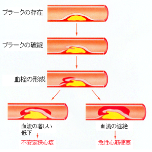 冠 症候群 急性